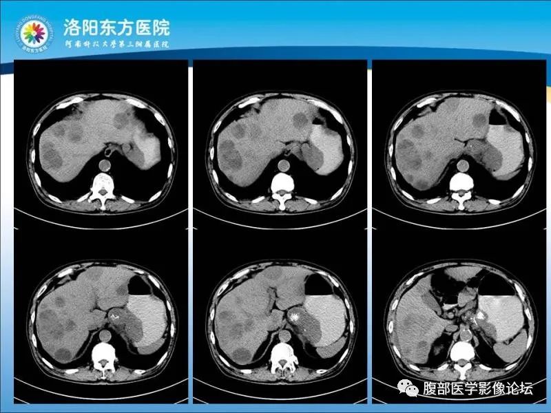 【病例】胃肝样腺癌肝内多发转移1例CT影像