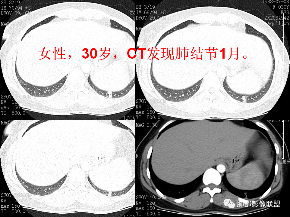 【病例】肺结节2例影像讨论