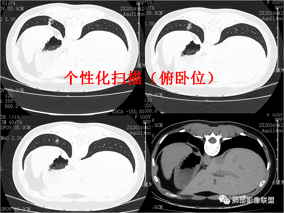 【病例】肺结节2例影像讨论