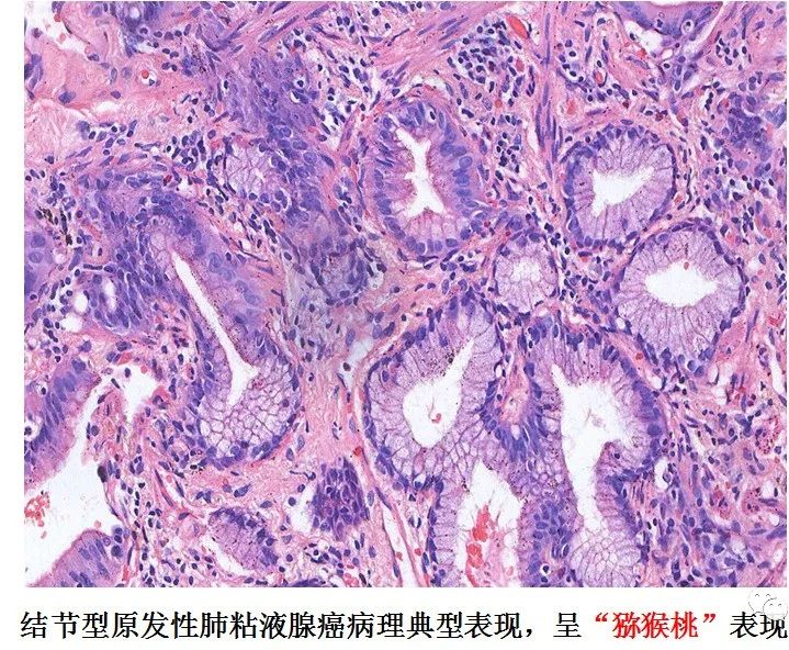 【病例】肺结节2例影像讨论