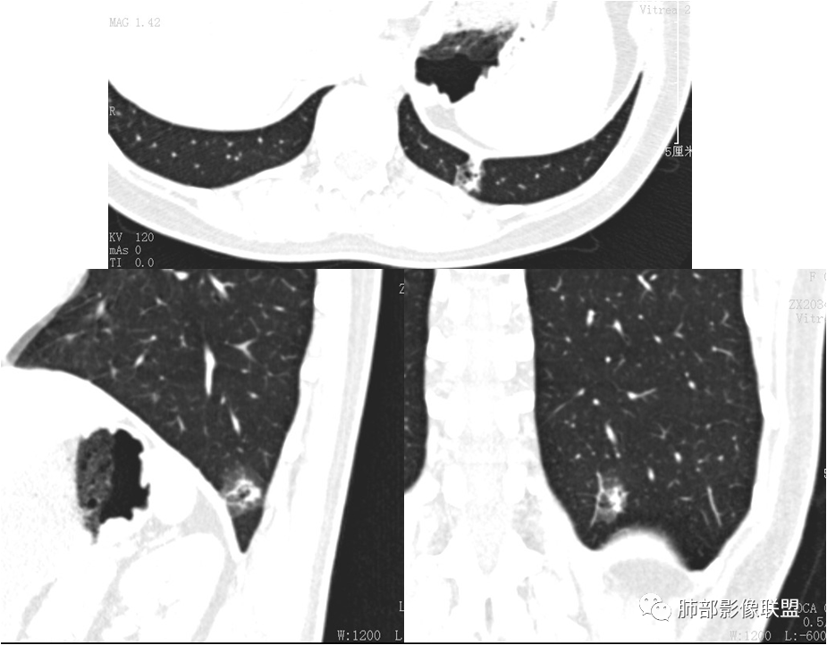 【病例】肺结节2例影像讨论