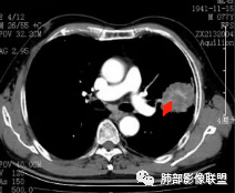 【病例】真假支气管爬行征—肺腺癌1例CT影像讨论