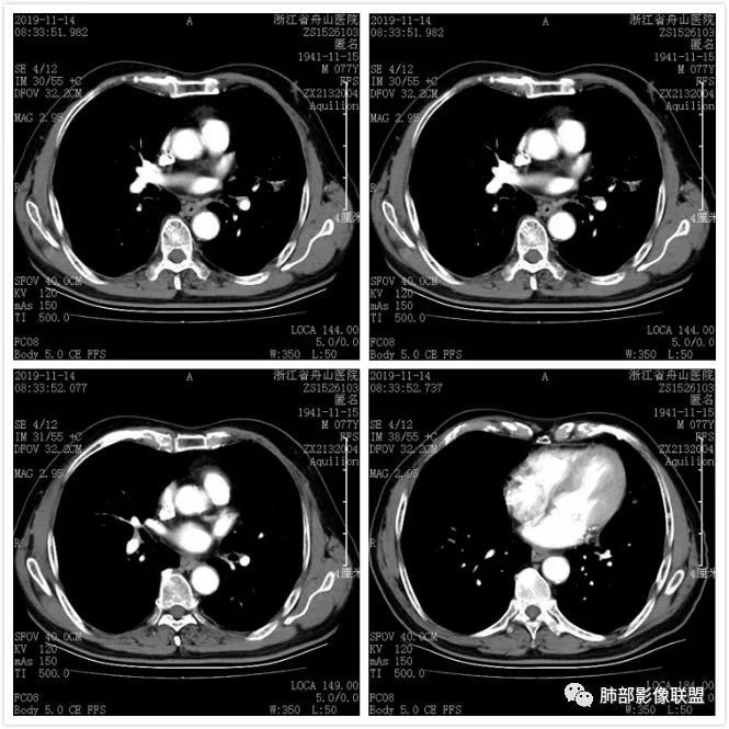 【病例】真假支气管爬行征—肺腺癌1例CT影像讨论