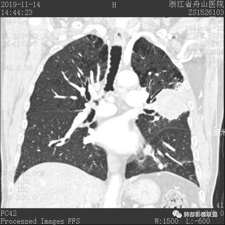 【病例】真假支气管爬行征—肺腺癌1例CT影像讨论