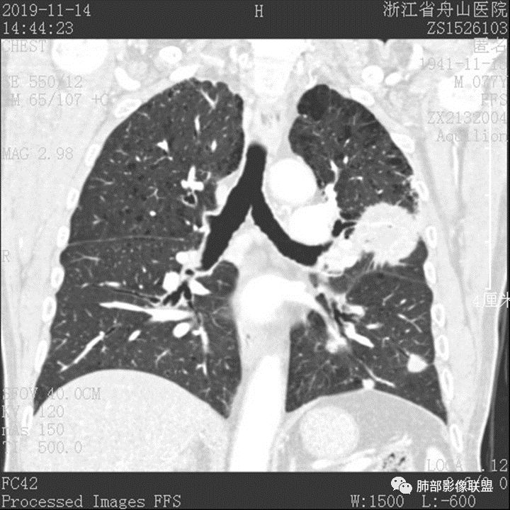 【病例】真假支气管爬行征—肺腺癌1例CT影像讨论
