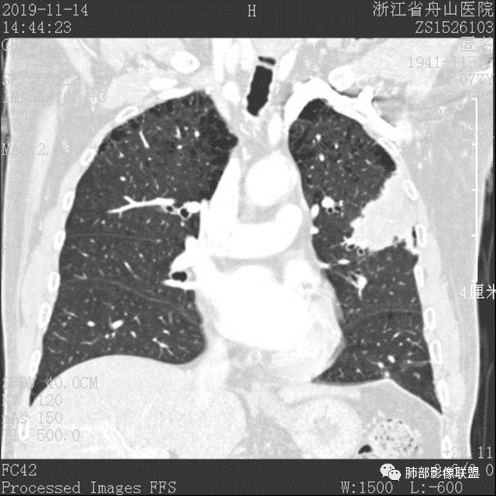 【病例】真假支气管爬行征—肺腺癌1例CT影像讨论