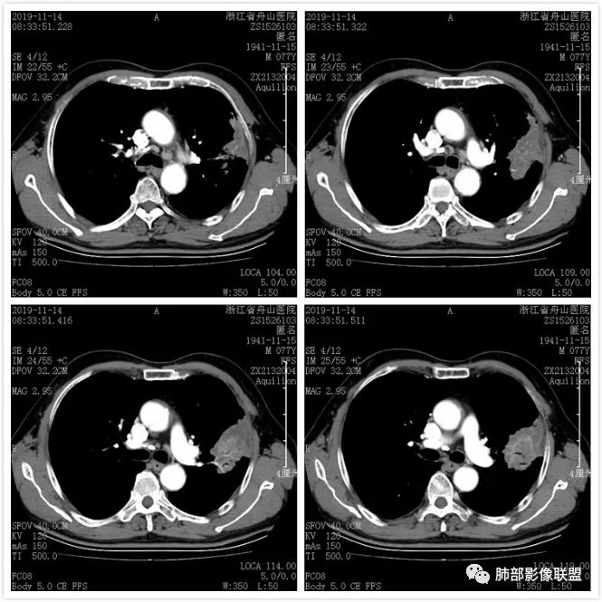 【病例】真假支气管爬行征—肺腺癌1例CT影像讨论