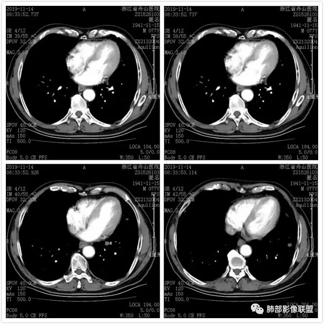 【病例】真假支气管爬行征—肺腺癌1例CT影像讨论