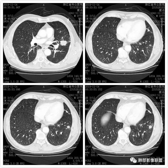 【病例】真假支气管爬行征—肺腺癌1例CT影像讨论