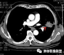 【病例】真假支气管爬行征—肺腺癌1例CT影像讨论