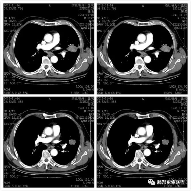 【病例】真假支气管爬行征—肺腺癌1例CT影像讨论