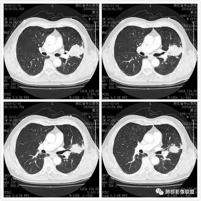 【病例】真假支气管爬行征—肺腺癌1例CT影像讨论