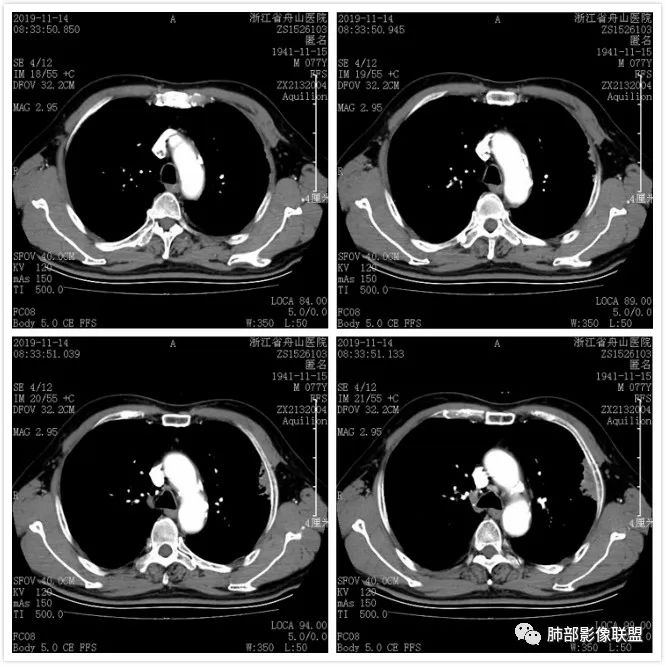 【病例】真假支气管爬行征—肺腺癌1例CT影像讨论