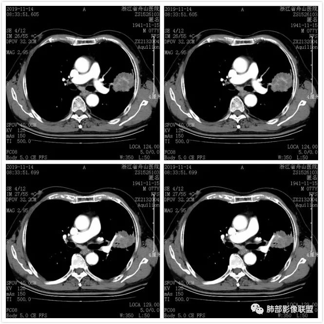 【病例】真假支气管爬行征—肺腺癌1例CT影像讨论