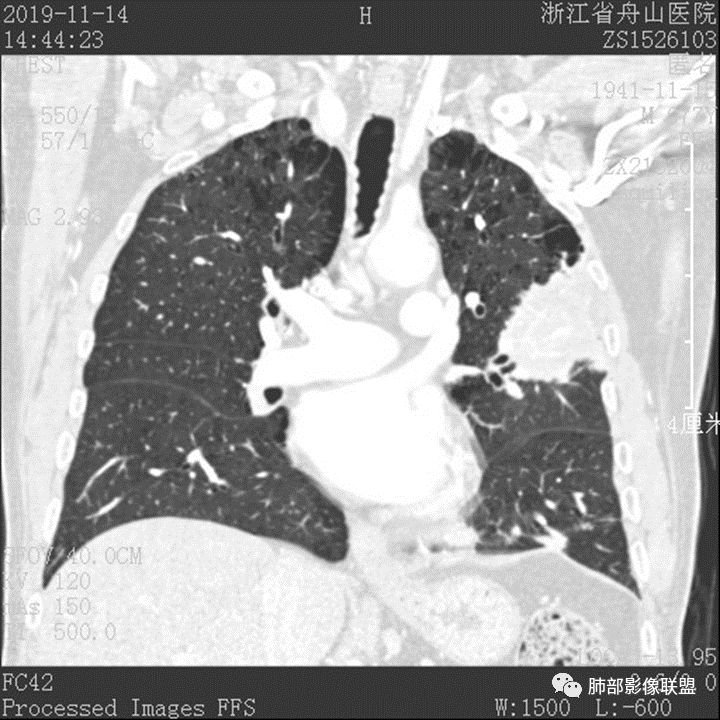 【病例】真假支气管爬行征—肺腺癌1例CT影像讨论