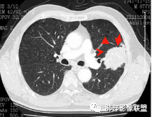 【病例】真假支气管爬行征—肺腺癌1例CT影像讨论