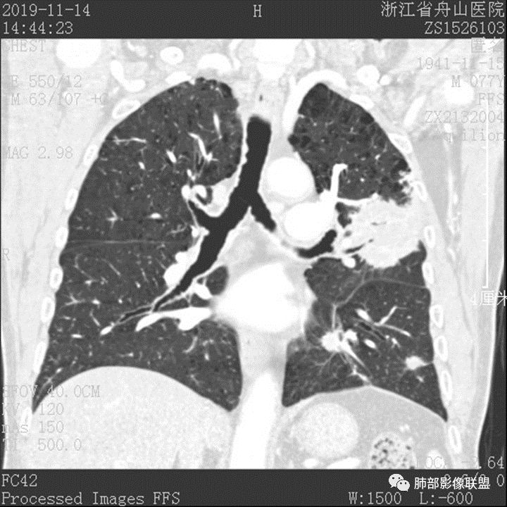 【病例】真假支气管爬行征—肺腺癌1例CT影像讨论