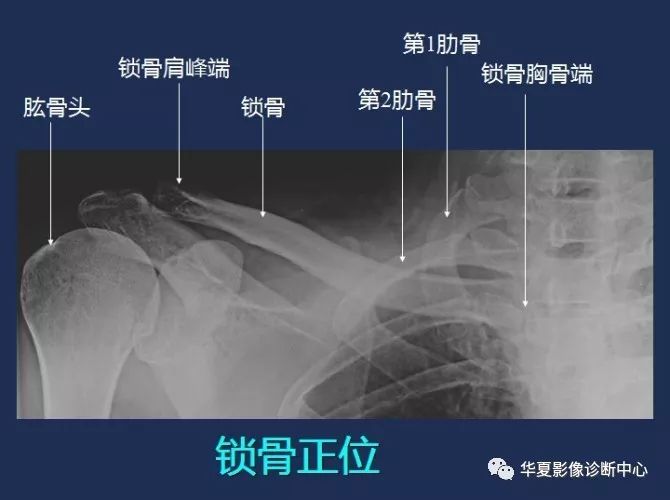 锁骨正位