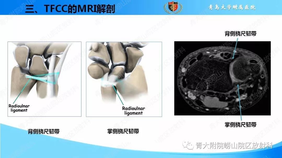 【PPT】TFCC损伤的MRI诊断
