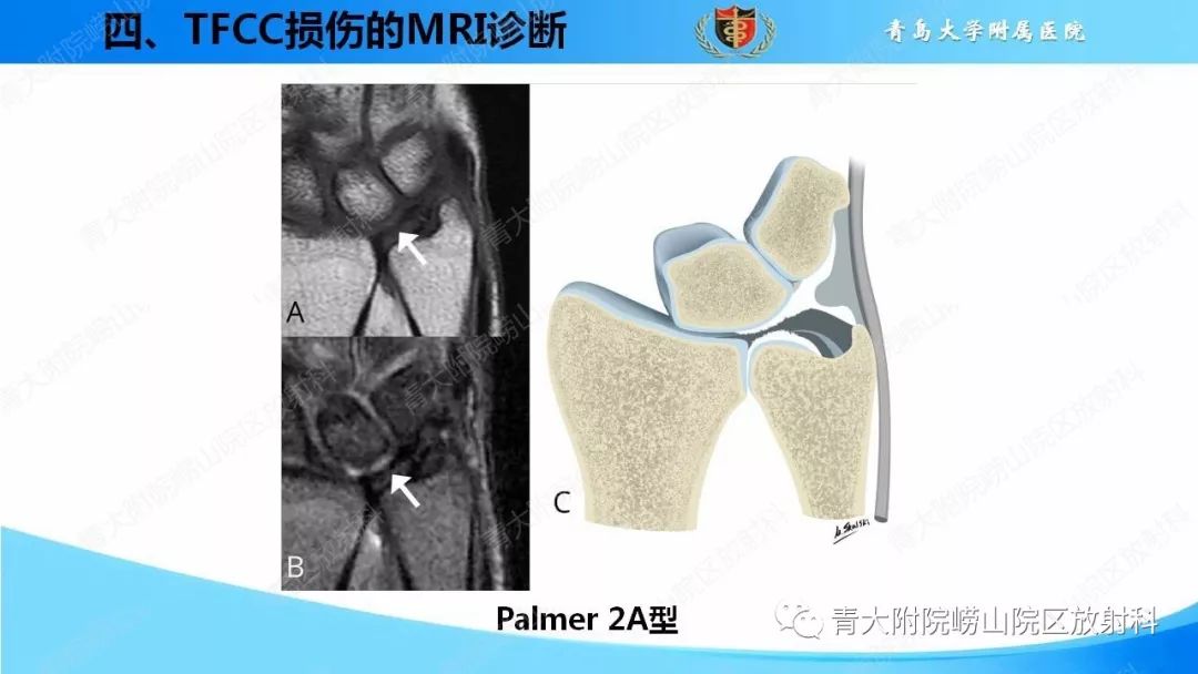 【PPT】TFCC损伤的MRI诊断