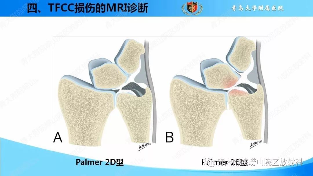 【PPT】TFCC损伤的MRI诊断