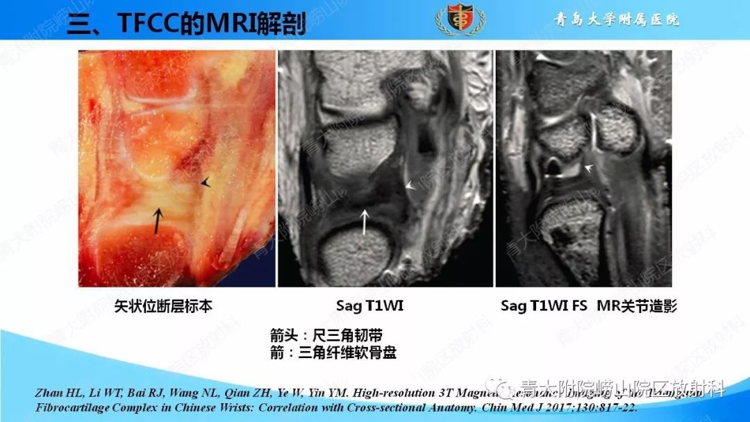 【PPT】TFCC损伤的MRI诊断