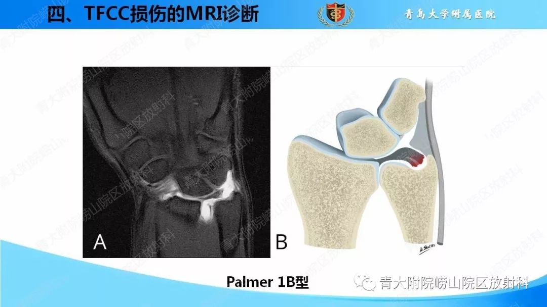 【PPT】TFCC损伤的MRI诊断
