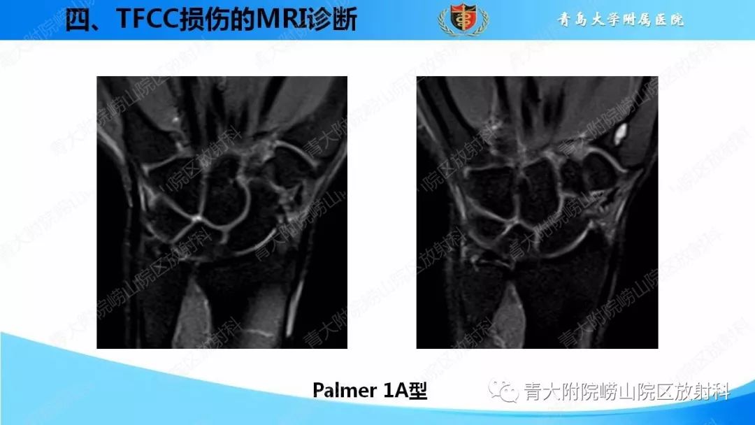 【PPT】TFCC损伤的MRI诊断