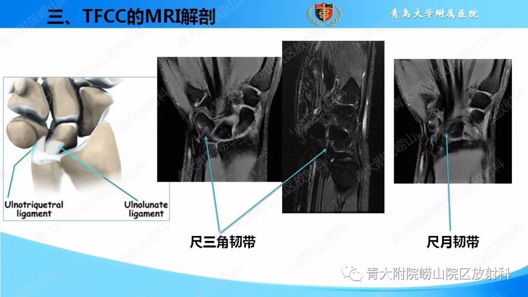 【PPT】TFCC损伤的MRI诊断