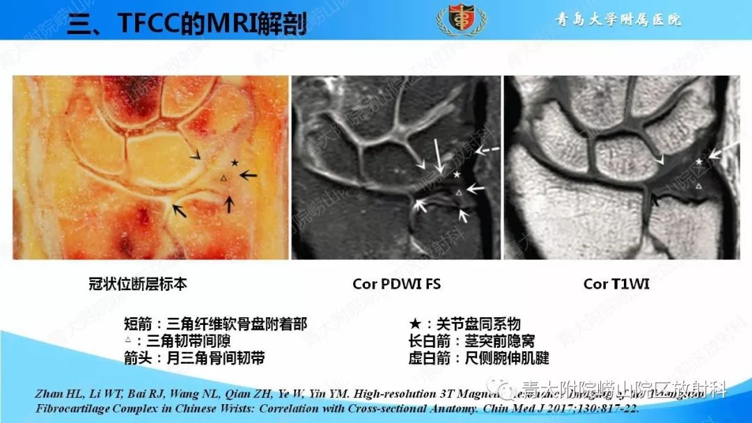 【PPT】TFCC损伤的MRI诊断