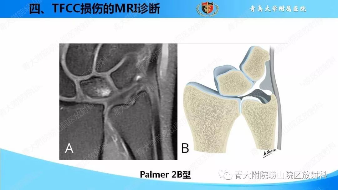 【PPT】TFCC损伤的MRI诊断