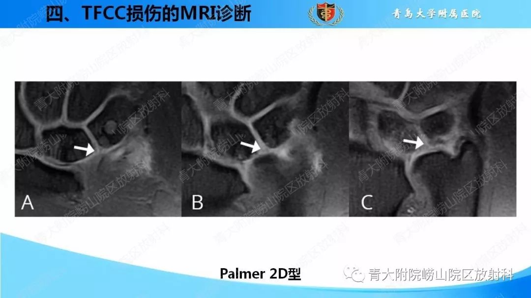 【PPT】TFCC损伤的MRI诊断