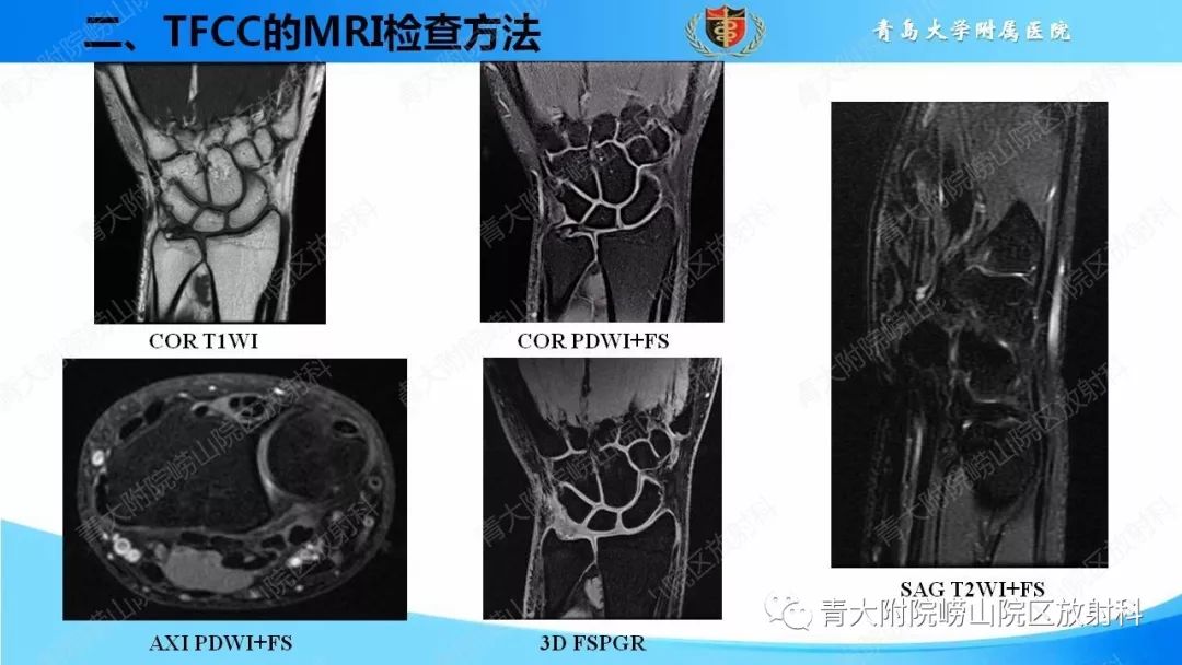 【PPT】TFCC损伤的MRI诊断