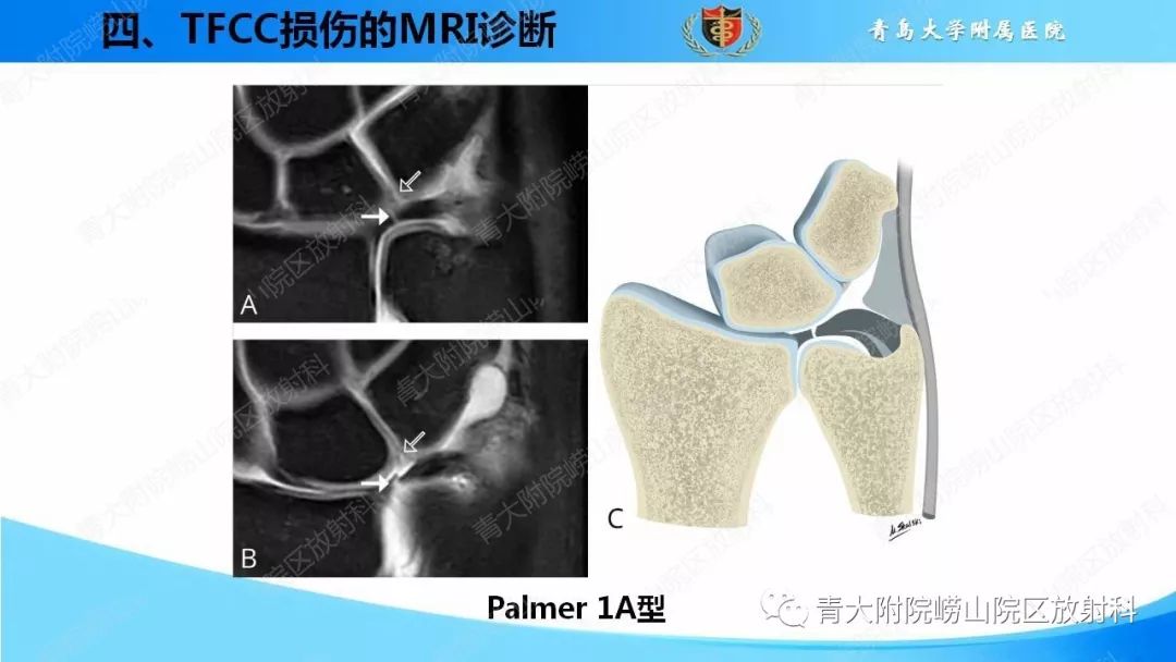 【PPT】TFCC损伤的MRI诊断