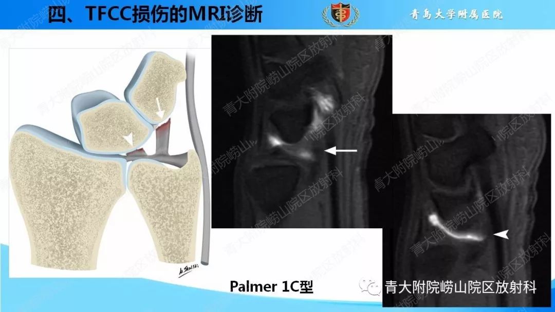 【PPT】TFCC损伤的MRI诊断