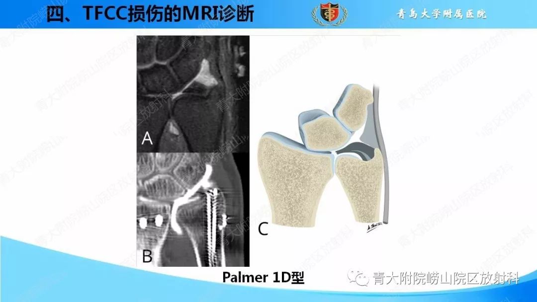 【PPT】TFCC损伤的MRI诊断