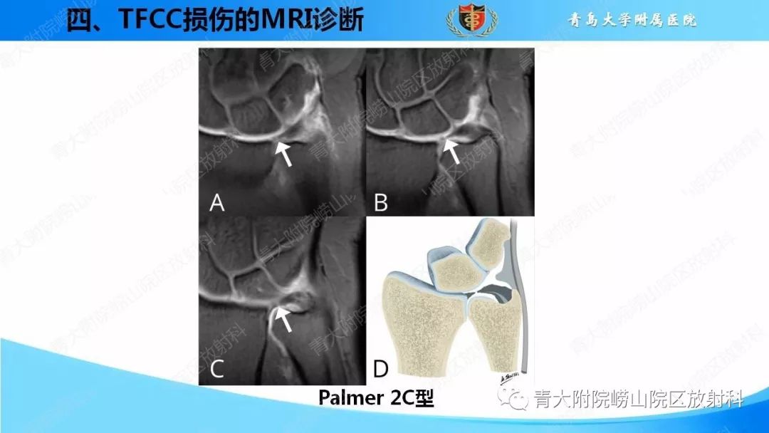 【PPT】TFCC损伤的MRI诊断