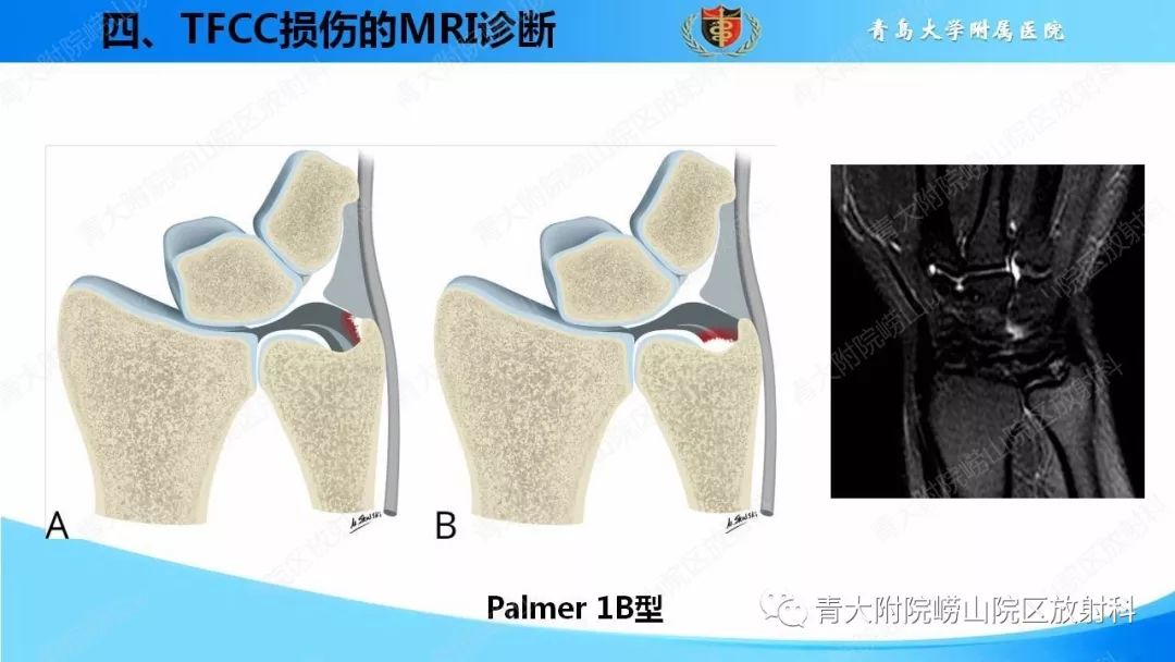 【PPT】TFCC损伤的MRI诊断