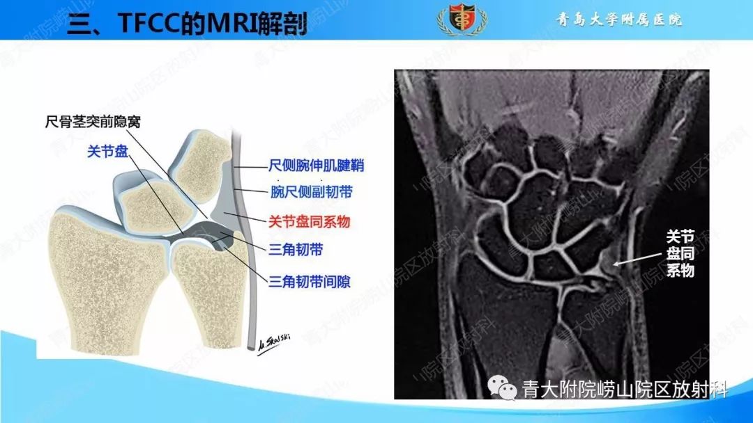 【PPT】TFCC损伤的MRI诊断
