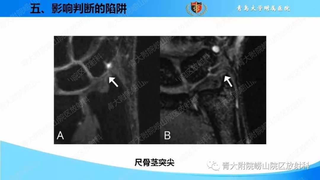 【PPT】TFCC损伤的MRI诊断