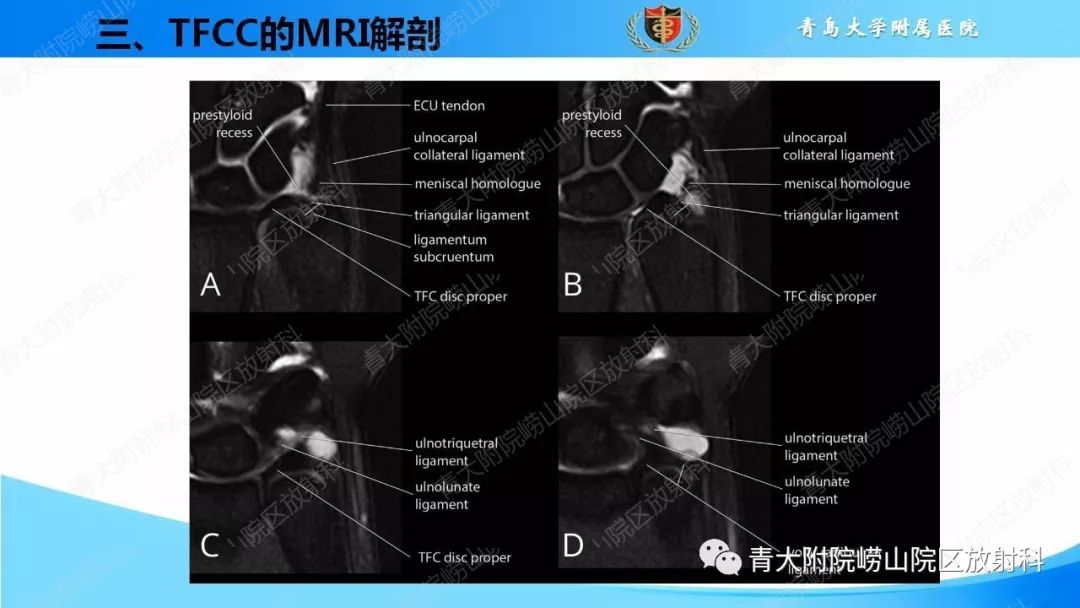 【PPT】TFCC损伤的MRI诊断