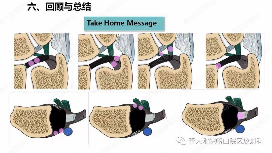 【PPT】TFCC损伤的MRI诊断