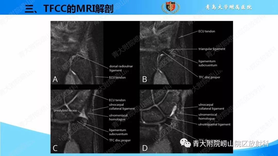 【PPT】TFCC损伤的MRI诊断