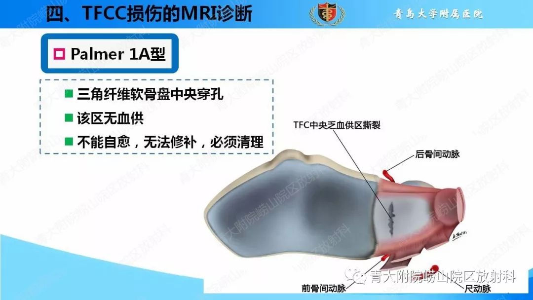 【PPT】TFCC损伤的MRI诊断