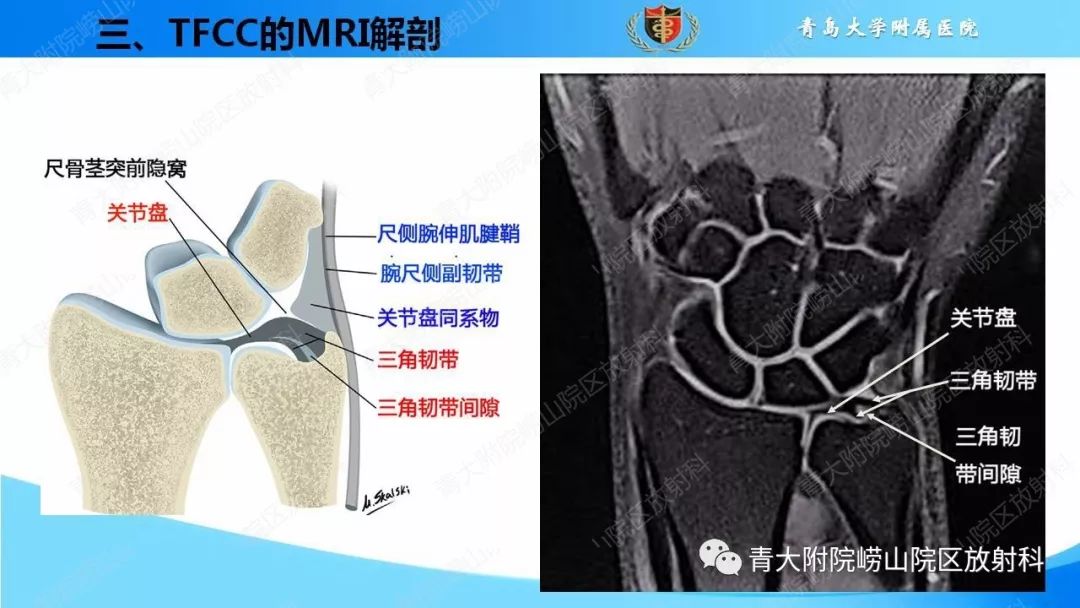 【PPT】TFCC损伤的MRI诊断