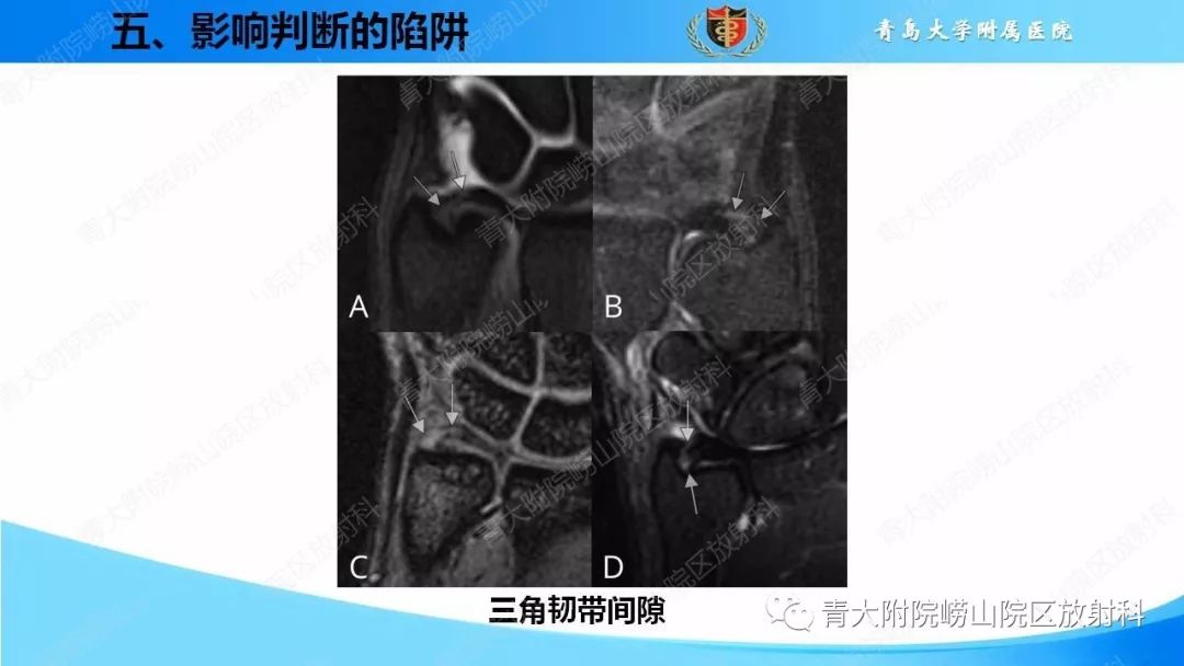 【PPT】TFCC损伤的MRI诊断
