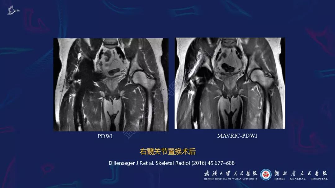 【PPT】肌骨MRI金属伪影抑制技术临床应用