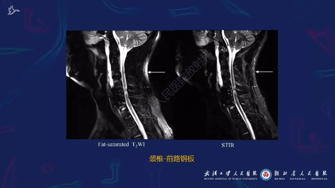 【PPT】肌骨MRI金属伪影抑制技术临床应用