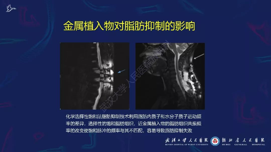 【PPT】肌骨MRI金属伪影抑制技术临床应用