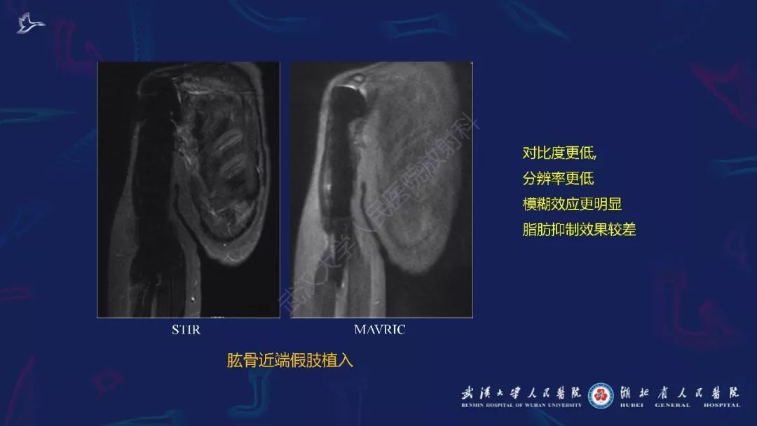 【PPT】肌骨MRI金属伪影抑制技术临床应用